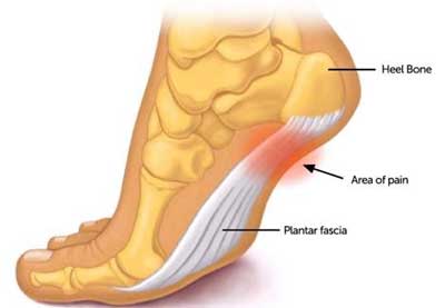 foot pain diagram