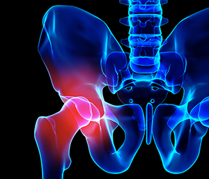 Hip Replacement Surgery Louisville KY
