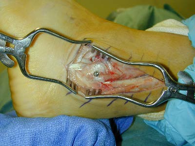 Intra Operative Appearance After Peroneal Retinacular Ligament Reconstruction and Fibular Osteotomy