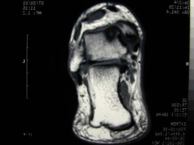 MRI of Angle Belonging to a 32-year-old Male