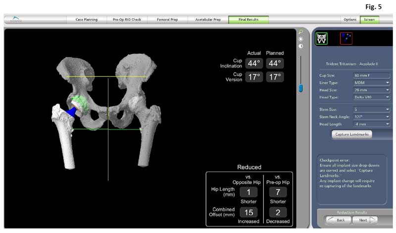 computer image of hip and pelvis