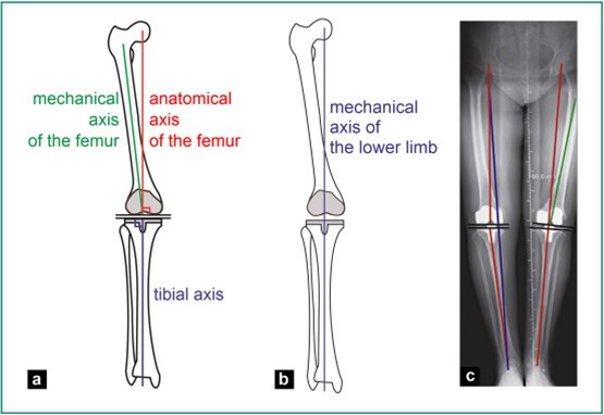 Robotic Knee Replacement Figure 1